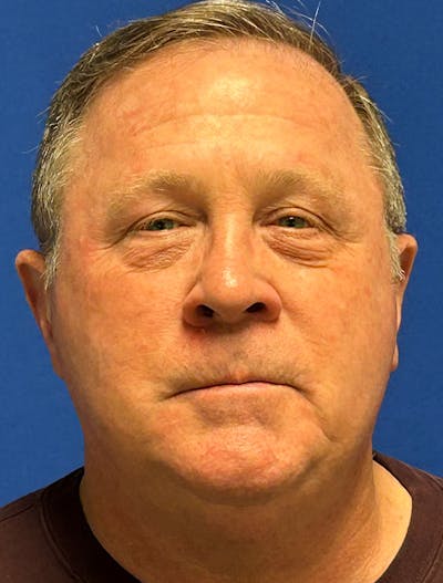 Laser Skin Resurfacing Before & After Gallery - Patient 151357 - Image 2