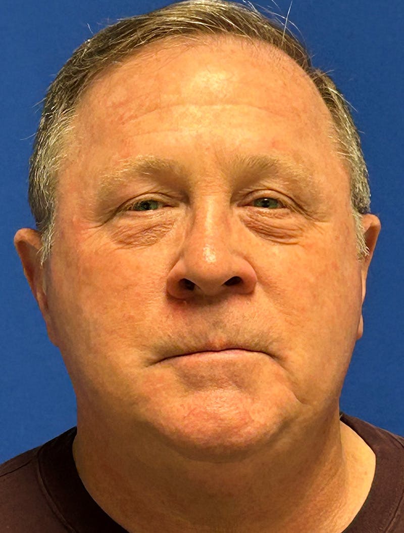 Laser Skin Resurfacing Before & After Gallery - Patient 151357 - Image 2