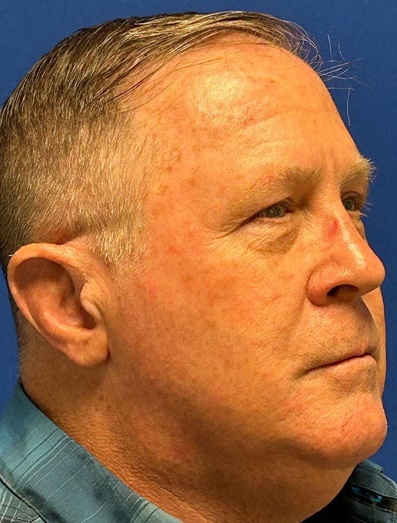 Laser Skin Resurfacing Before & After Gallery - Patient 151357 - Image 3