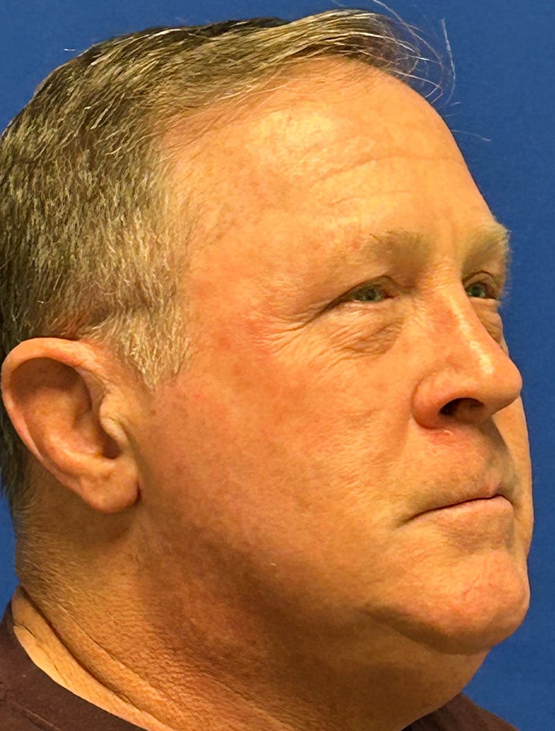 Laser Skin Resurfacing Before & After Gallery - Patient 151357 - Image 4