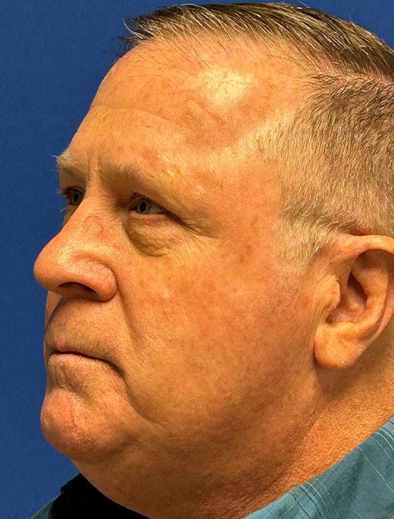 Laser Skin Resurfacing Before & After Gallery - Patient 151357 - Image 5