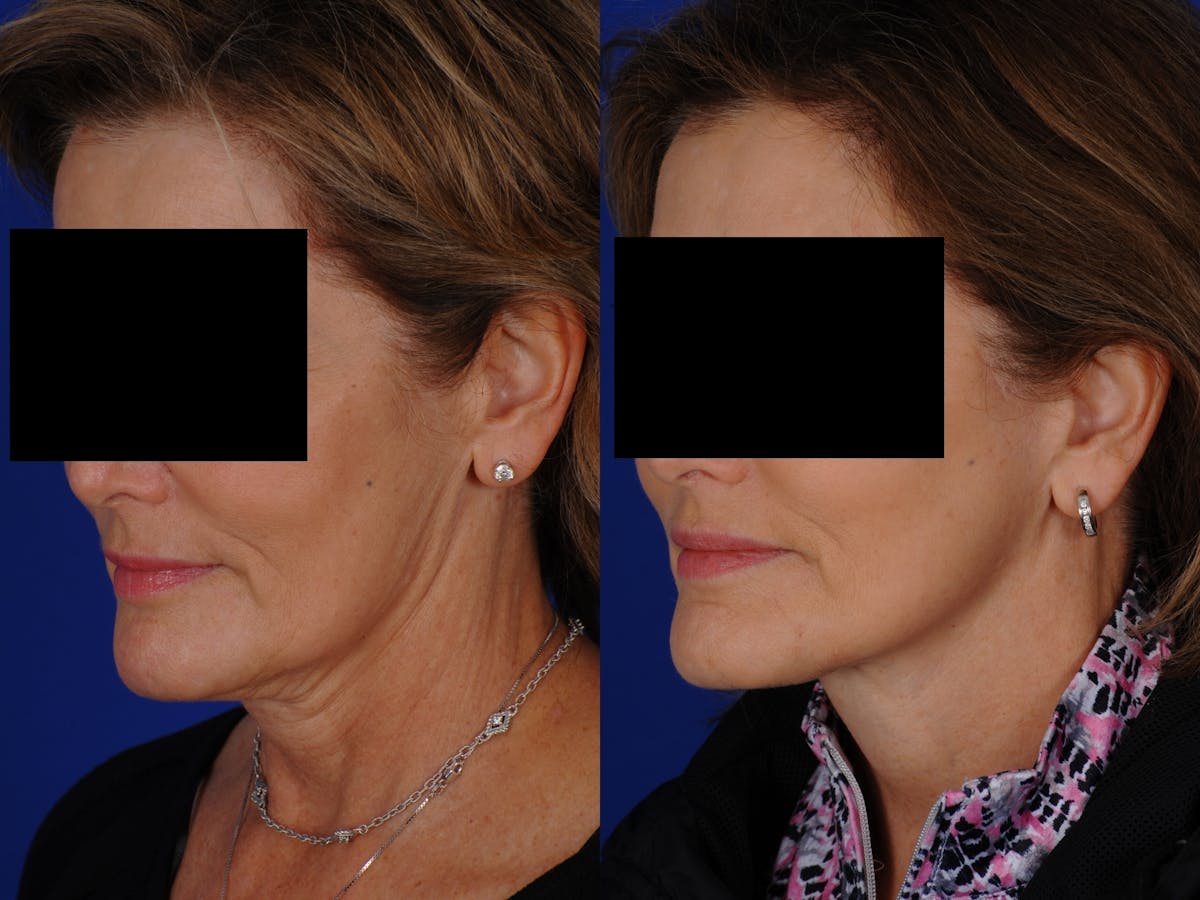 Neck Lift Before & After Gallery - Patient 139913 - Image 1