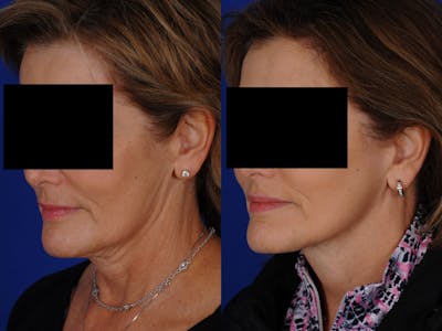 Neck Lift Before & After Gallery - Patient 139913 - Image 1