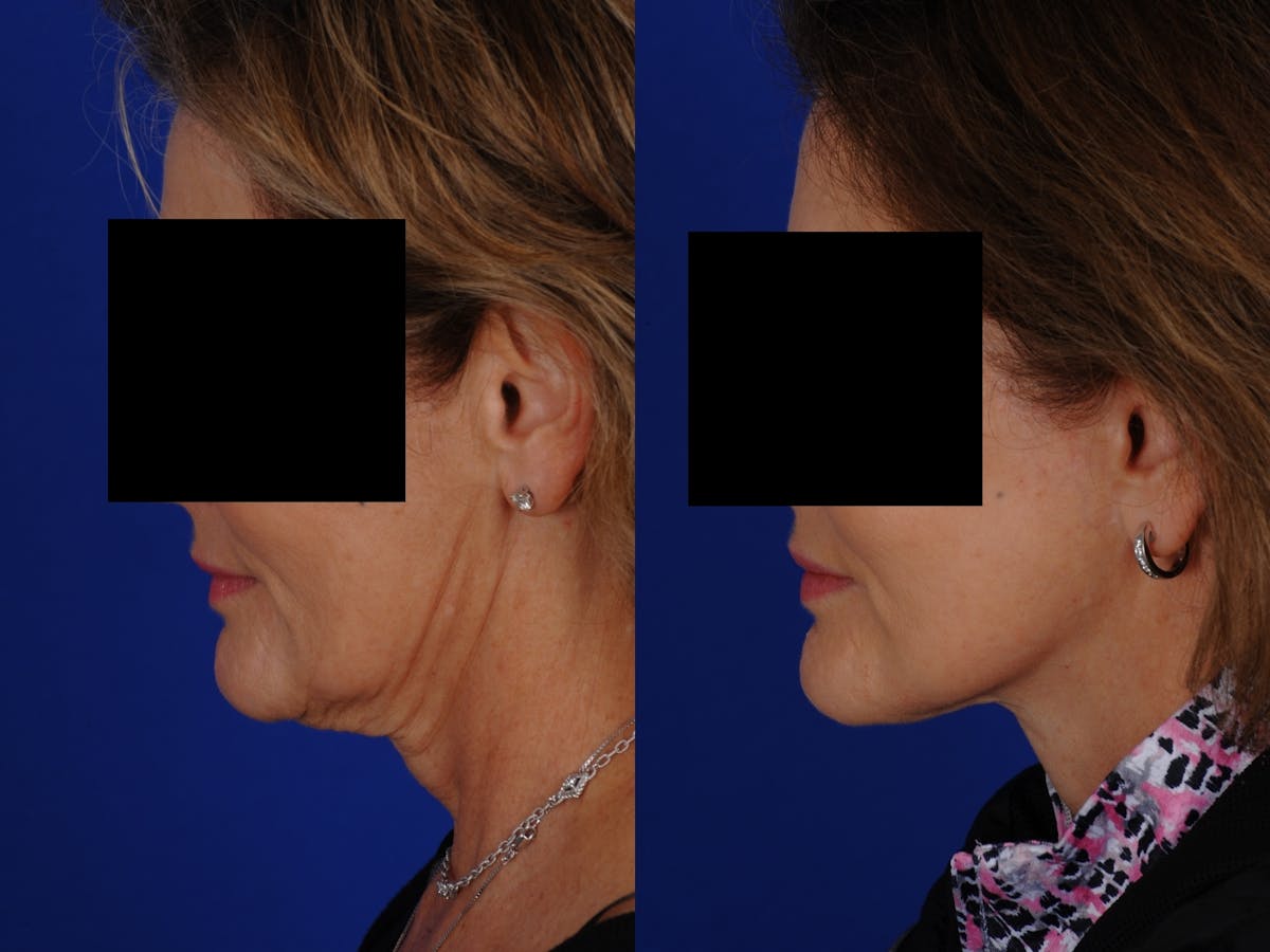 Neck Lift Before & After Gallery - Patient 139913 - Image 3
