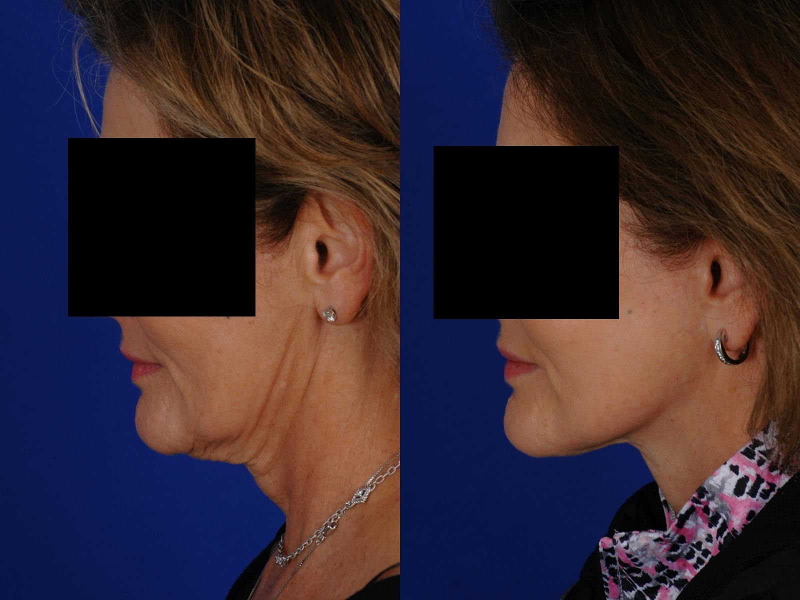 Neck Lift Before & After Gallery - Patient 139913 - Image 3