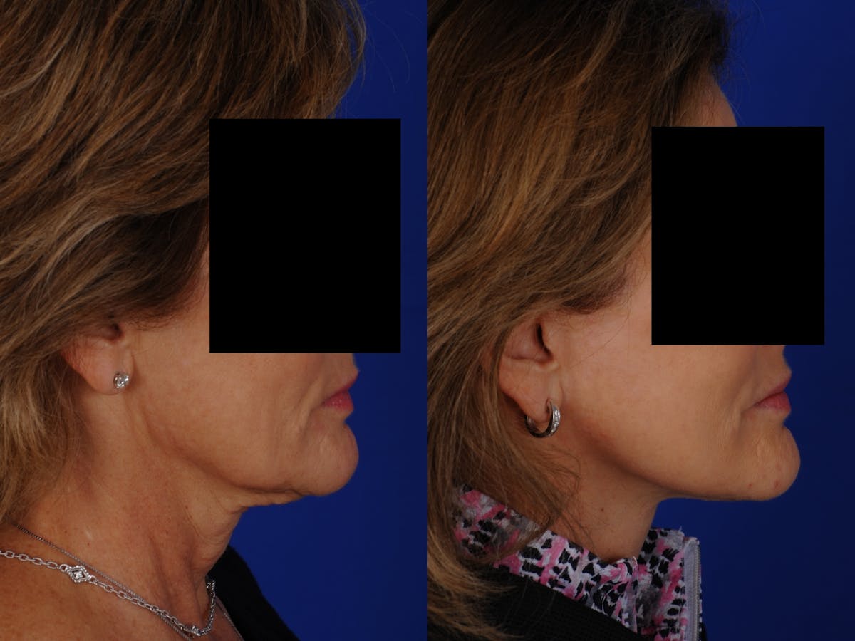 Neck Lift Before & After Gallery - Patient 139913 - Image 2
