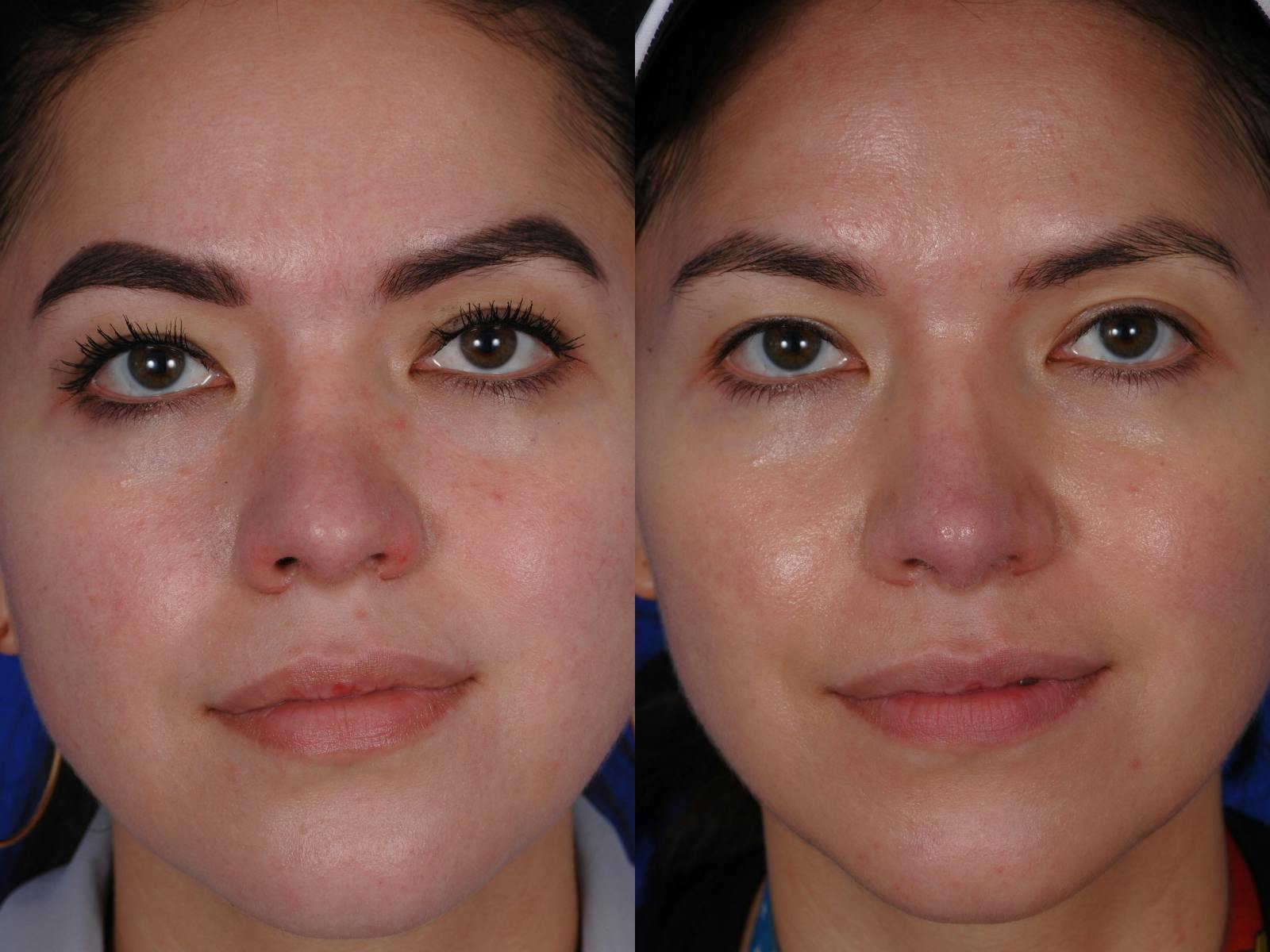 Revision Rhinoplasty Before & After Gallery - Patient 219017 - Image 1