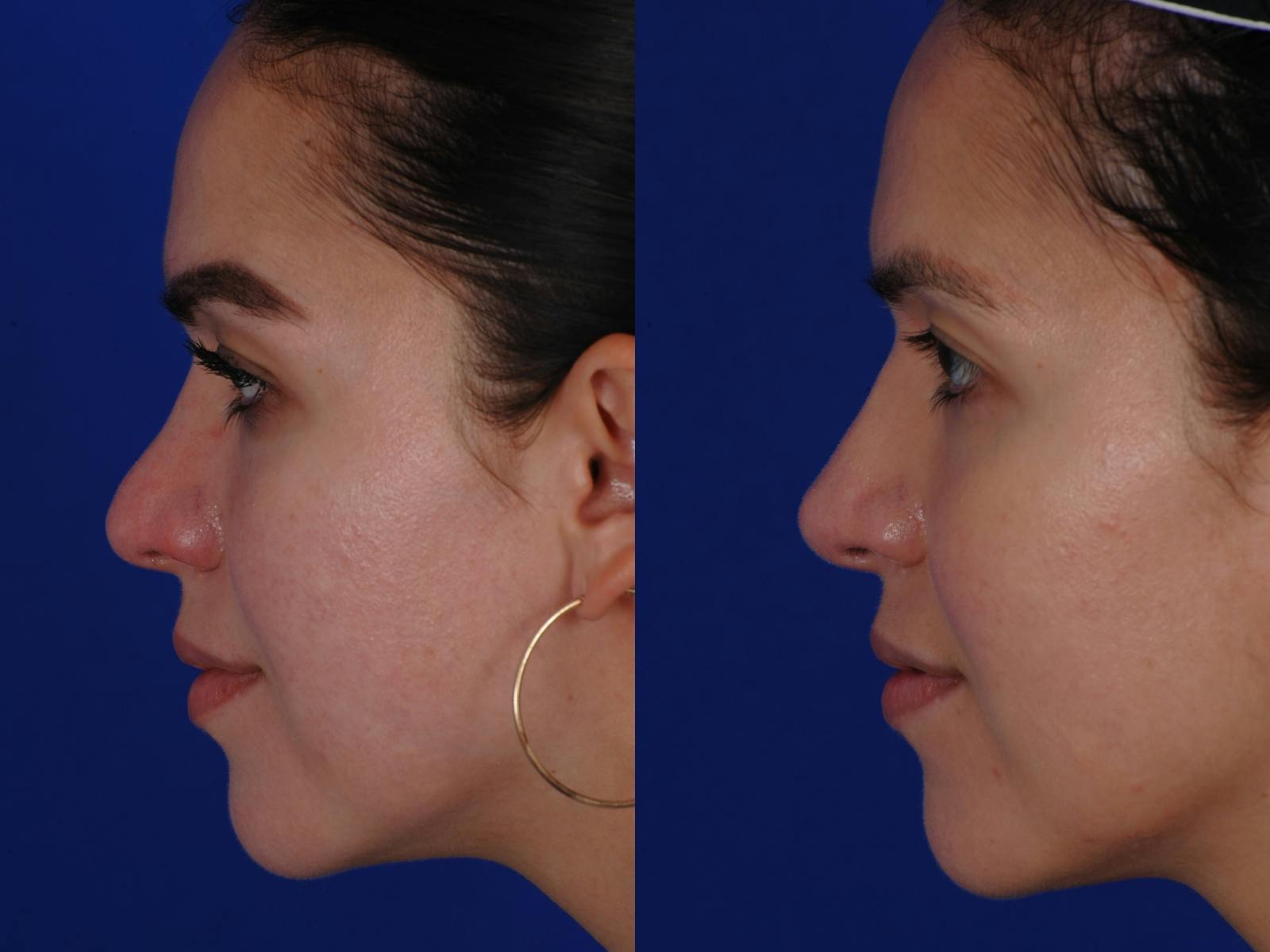 Revision Rhinoplasty Before & After Gallery - Patient 219017 - Image 5