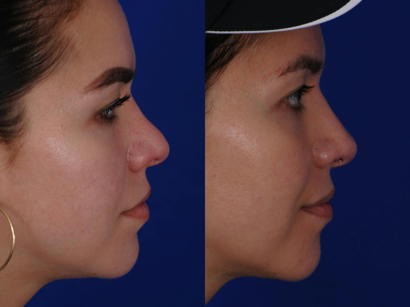 Revision Rhinoplasty Before & After Gallery - Patient 219017 - Image 3