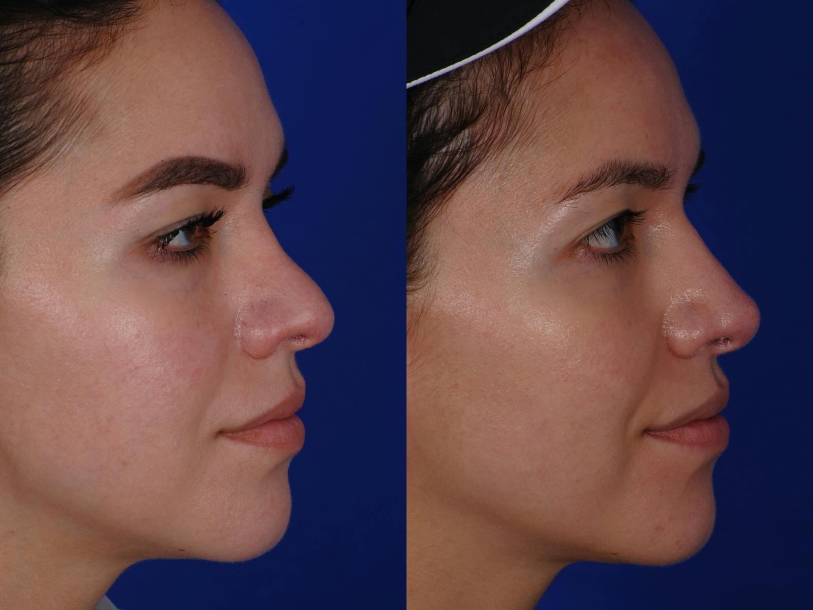 Revision Rhinoplasty Before & After Gallery - Patient 219017 - Image 2
