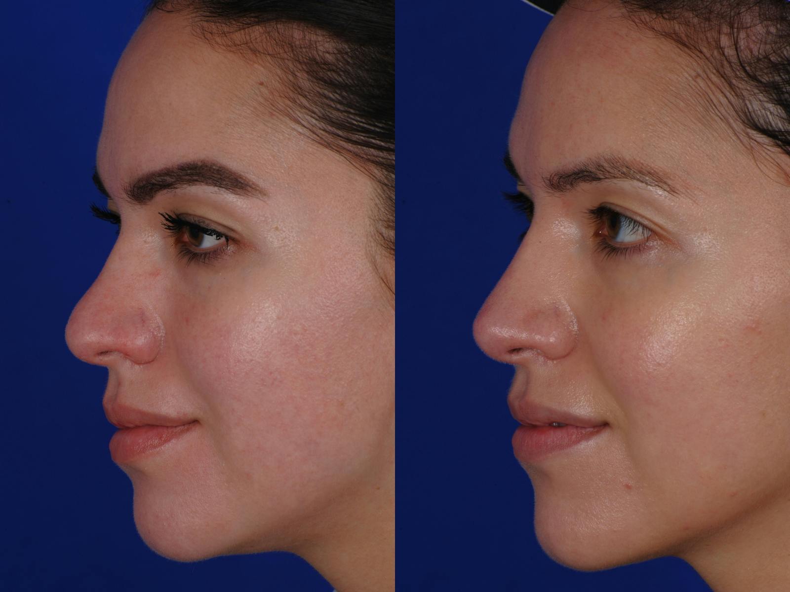 Revision Rhinoplasty Before & After Gallery - Patient 219017 - Image 4