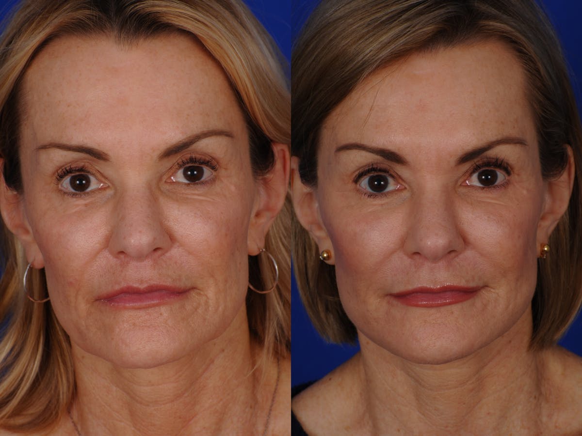 Neck Lift Before & After Gallery - Patient 359579 - Image 1