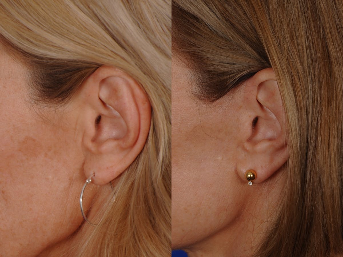 Neck Lift Before & After Gallery - Patient 359579 - Image 6