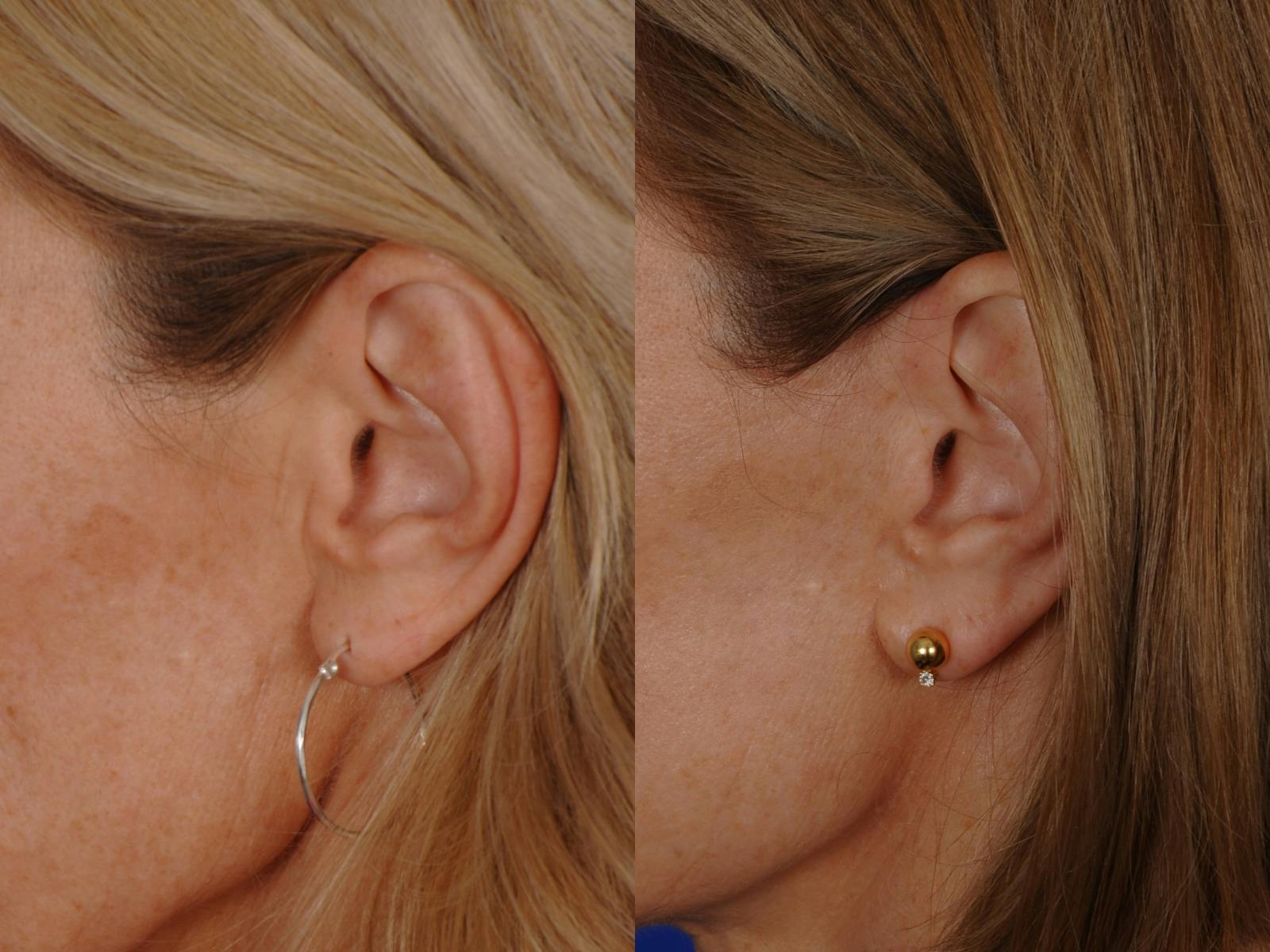 Neck Lift Before & After Gallery - Patient 359579 - Image 6