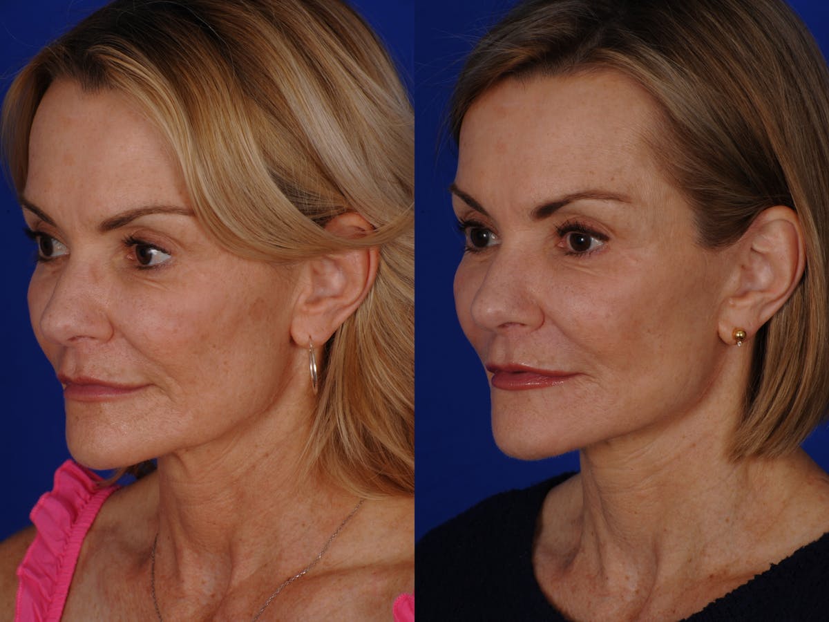 Neck Lift Before & After Gallery - Patient 359579 - Image 4