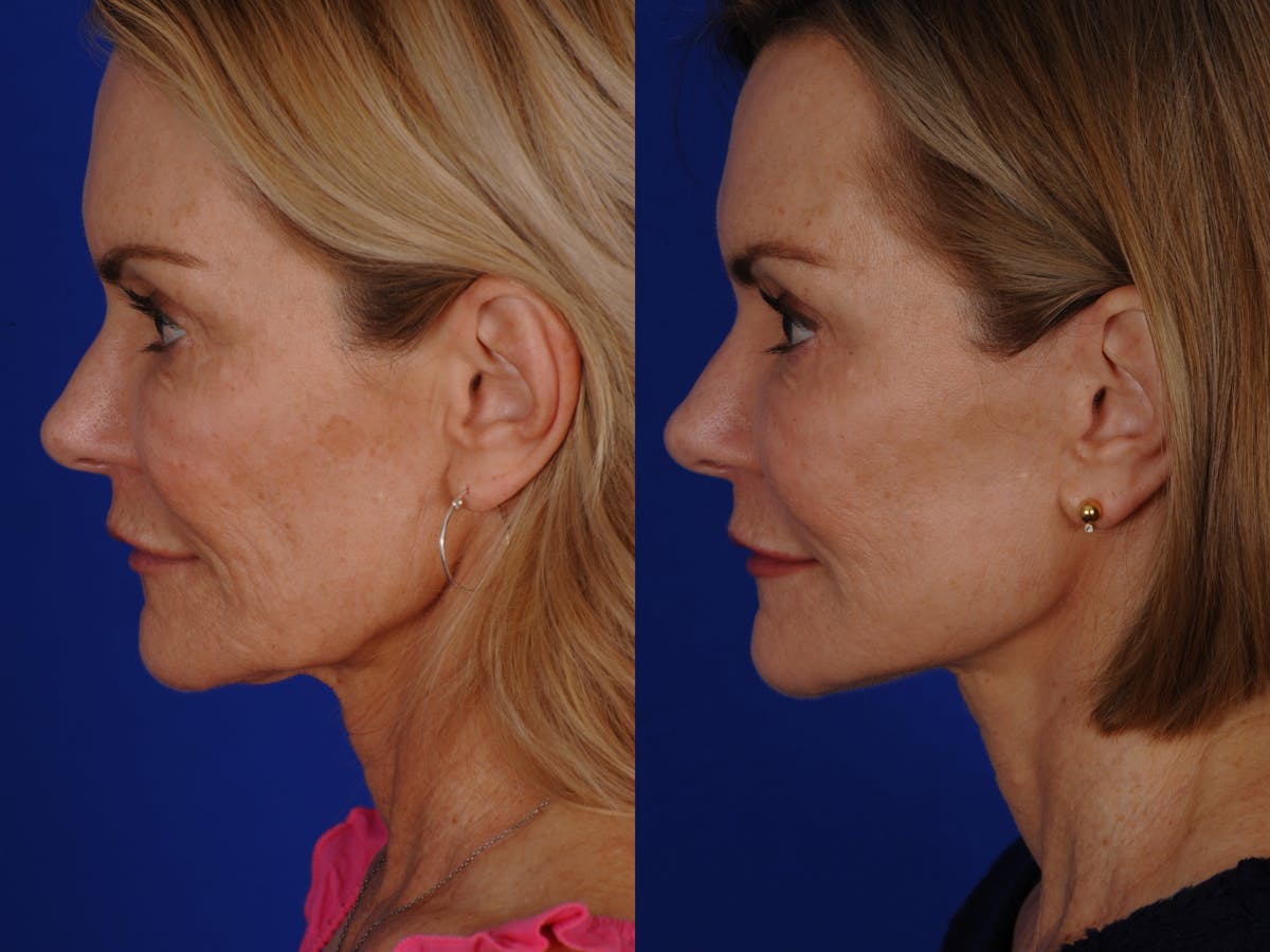 Neck Lift Before & After Gallery - Patient 359579 - Image 5