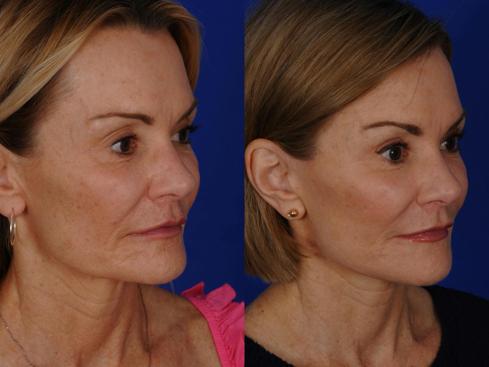 Neck Lift Before & After Gallery - Patient 359579 - Image 2
