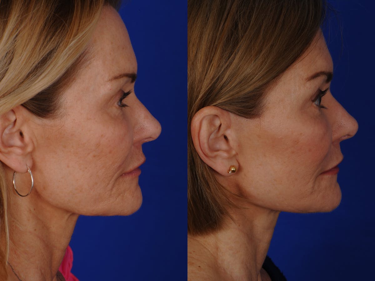 Neck Lift Before & After Gallery - Patient 359579 - Image 3