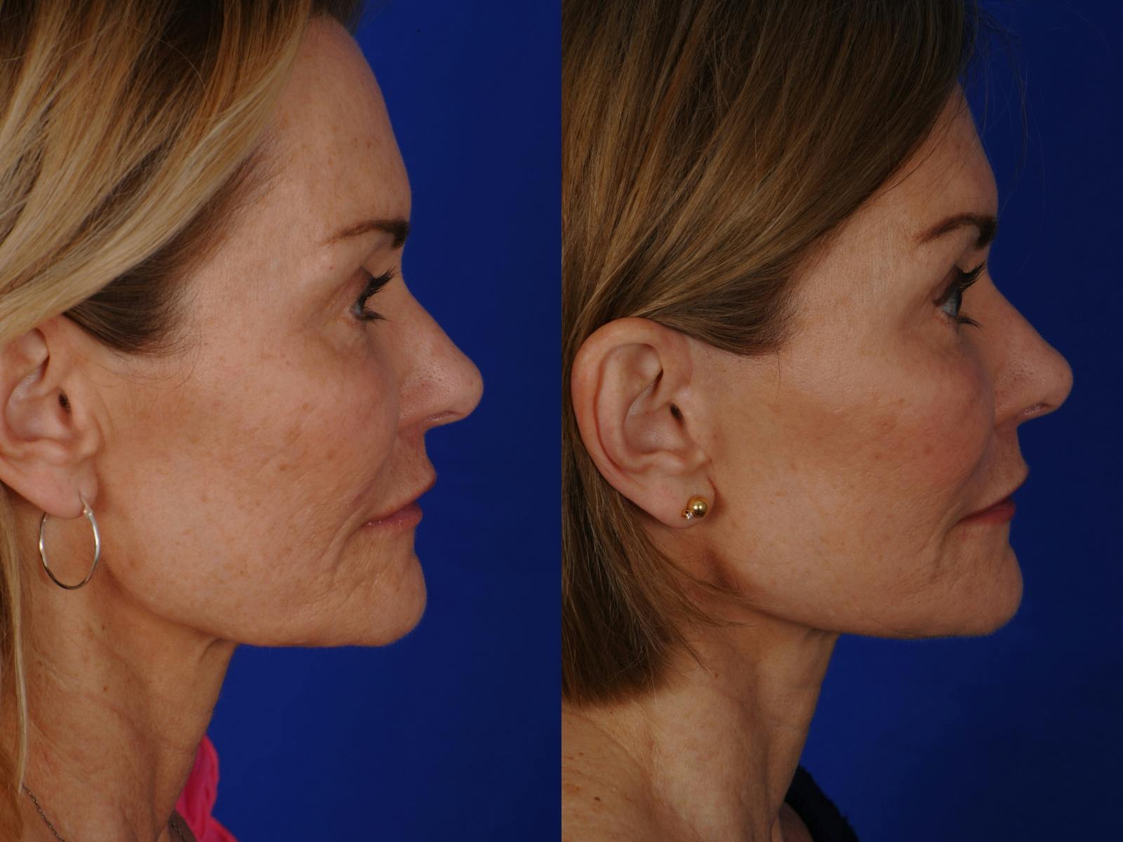 Neck Lift Before & After Gallery - Patient 359579 - Image 3