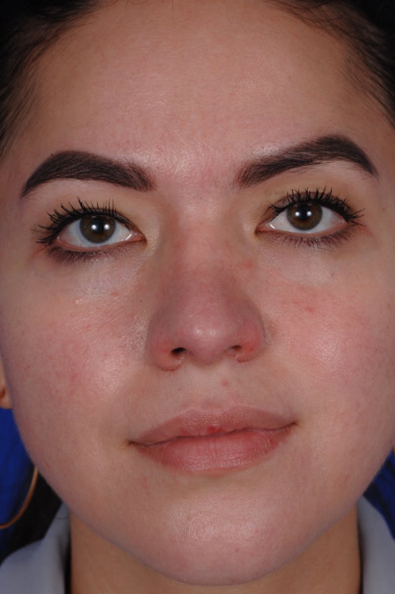 Revision Rhinoplasty Before & After Gallery - Patient 219017 - Image 1