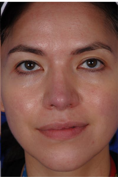 Revision Rhinoplasty Before & After Gallery - Patient 219017 - Image 2