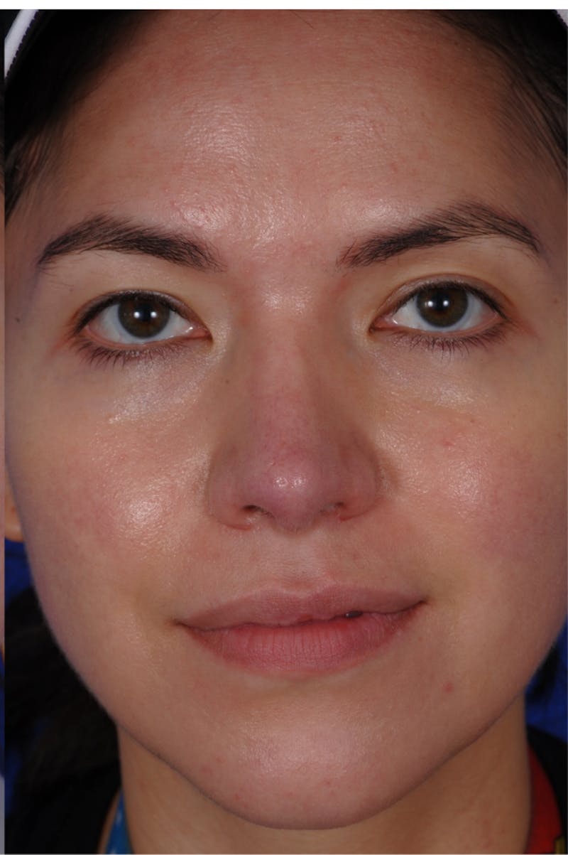 Revision Rhinoplasty Before & After Gallery - Patient 219017 - Image 2