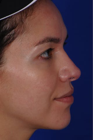 Revision Rhinoplasty Before & After Gallery - Patient 219017 - Image 10