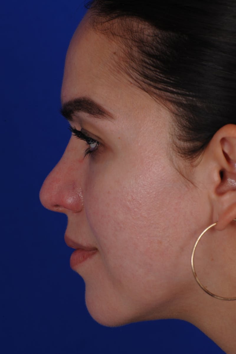 Revision Rhinoplasty Before & After Gallery - Patient 219017 - Image 3