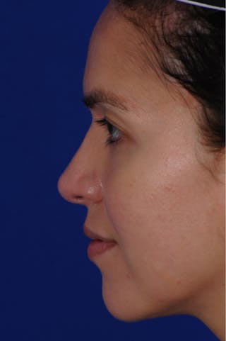 Revision Rhinoplasty Before & After Gallery - Patient 219017 - Image 4