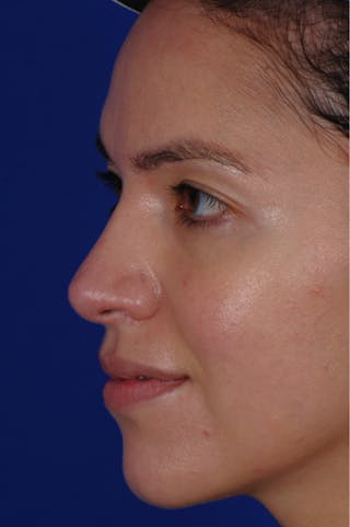 Revision Rhinoplasty Before & After Gallery - Patient 219017 - Image 6