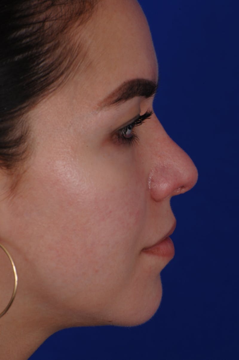 Revision Rhinoplasty Before & After Gallery - Patient 219017 - Image 7