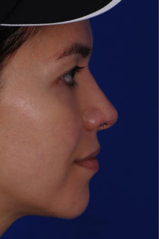 Revision Rhinoplasty Before & After Gallery - Patient 219017 - Image 8