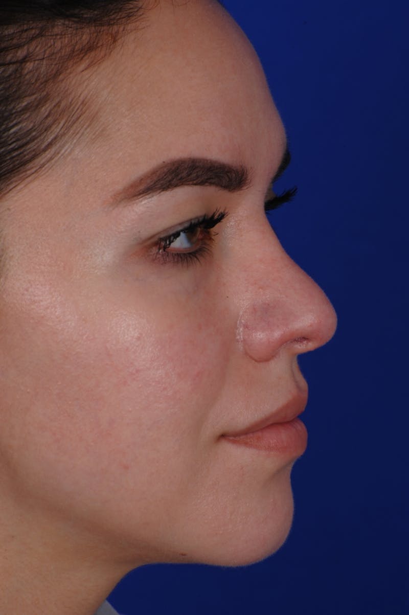 Revision Rhinoplasty Before & After Gallery - Patient 219017 - Image 9