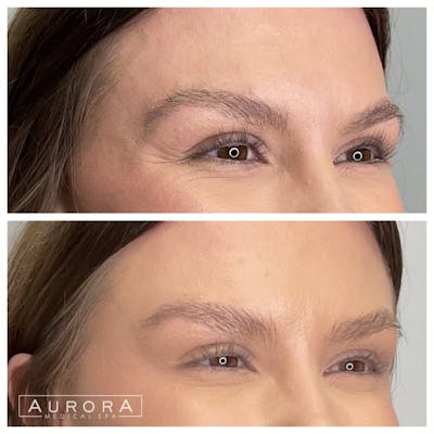 BOTOX Before & After Gallery - Patient 663294 - Image 1