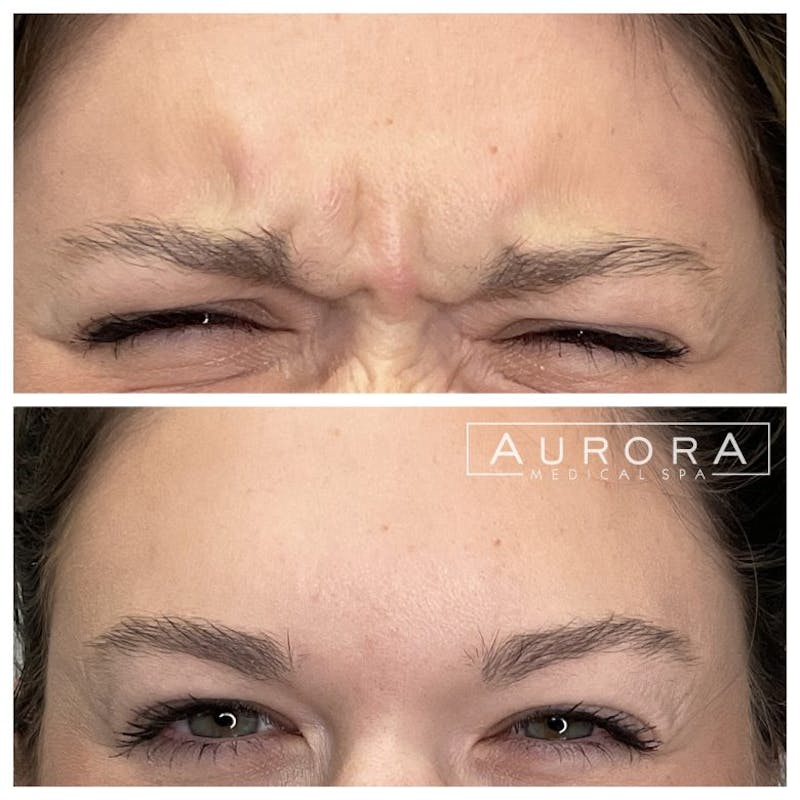 BOTOX Before & After Gallery - Patient 305610 - Image 1