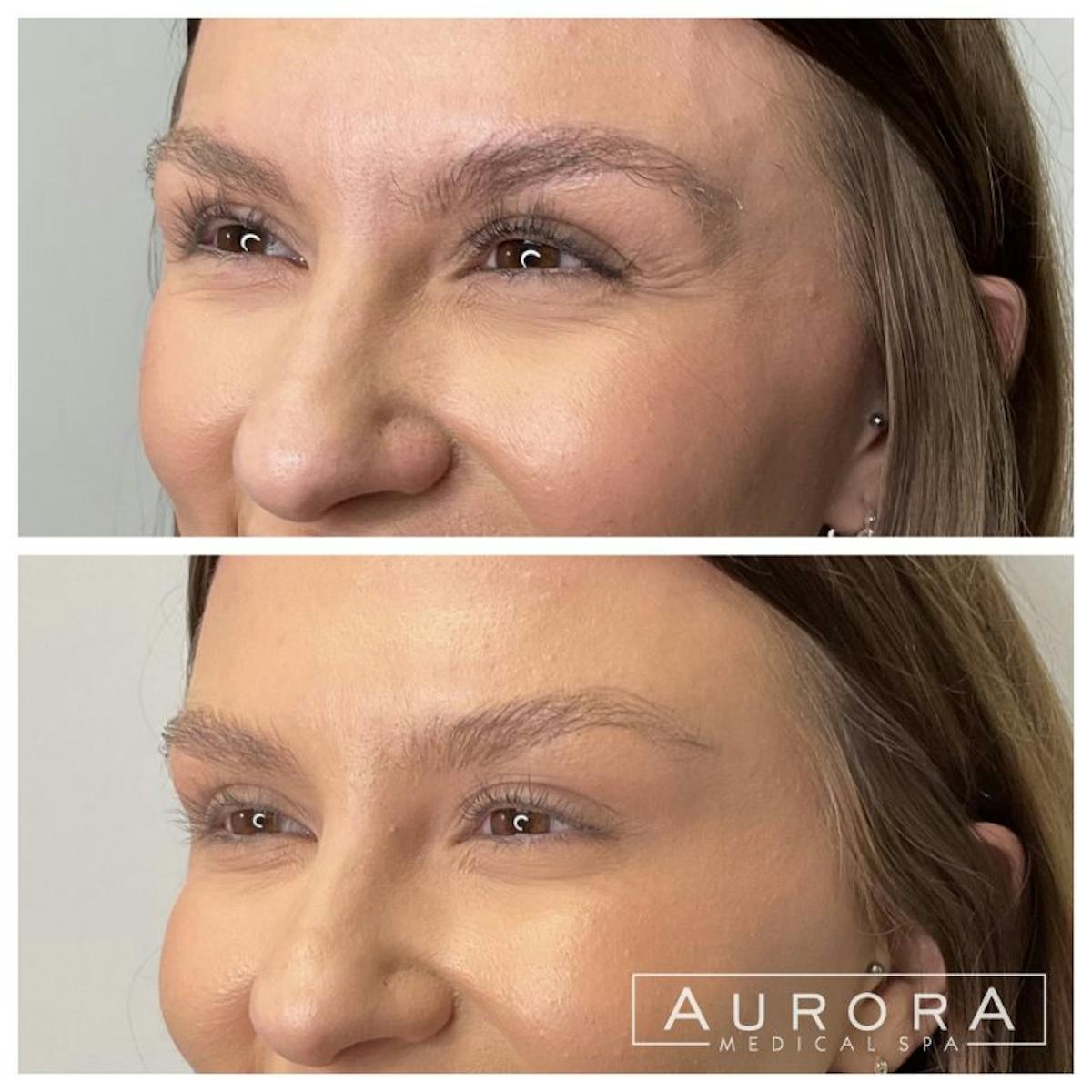 BOTOX Before & After Gallery - Patient 663294 - Image 2