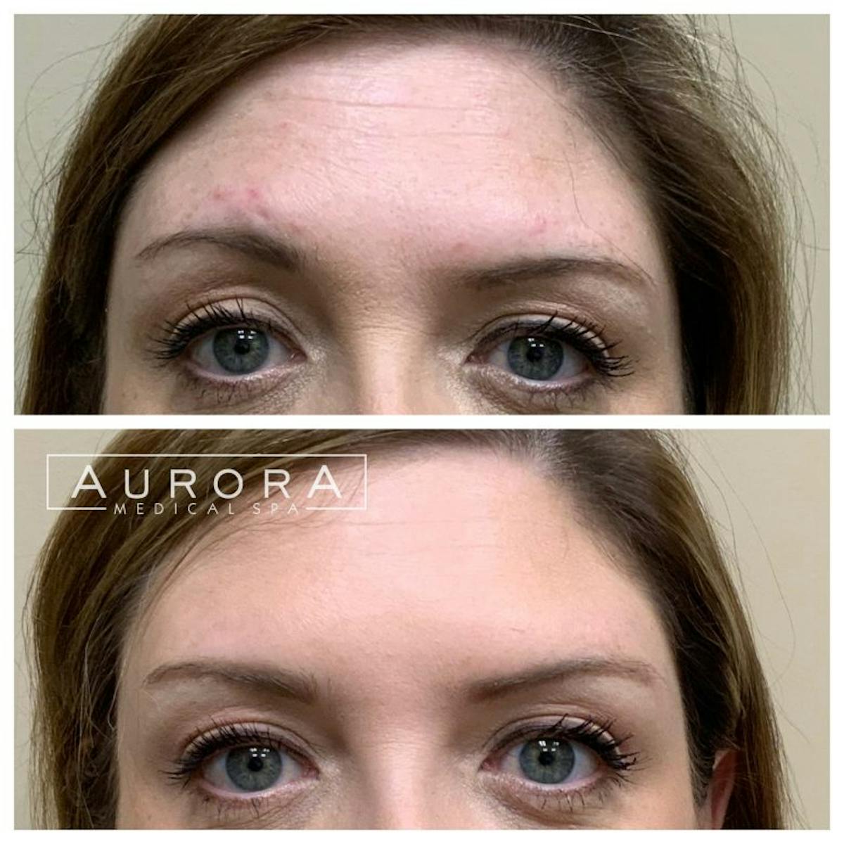 BOTOX Before & After Gallery - Patient 370810 - Image 1