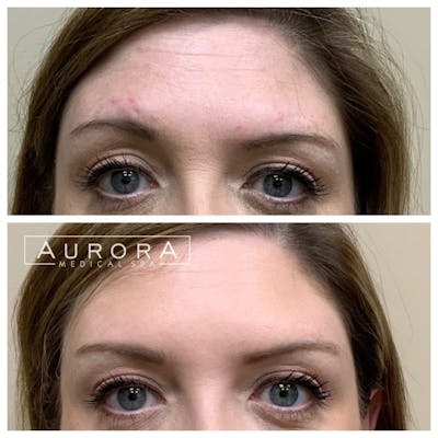 BOTOX Before & After Gallery - Patient 370810 - Image 1
