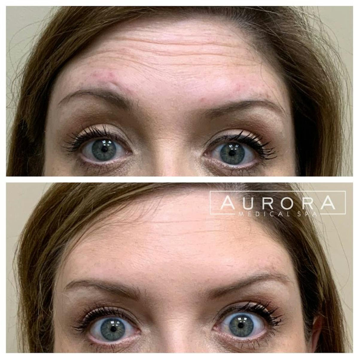BOTOX Before & After Gallery - Patient 370810 - Image 3