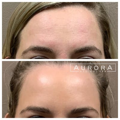 BOTOX Before & After Gallery - Patient 397432 - Image 1