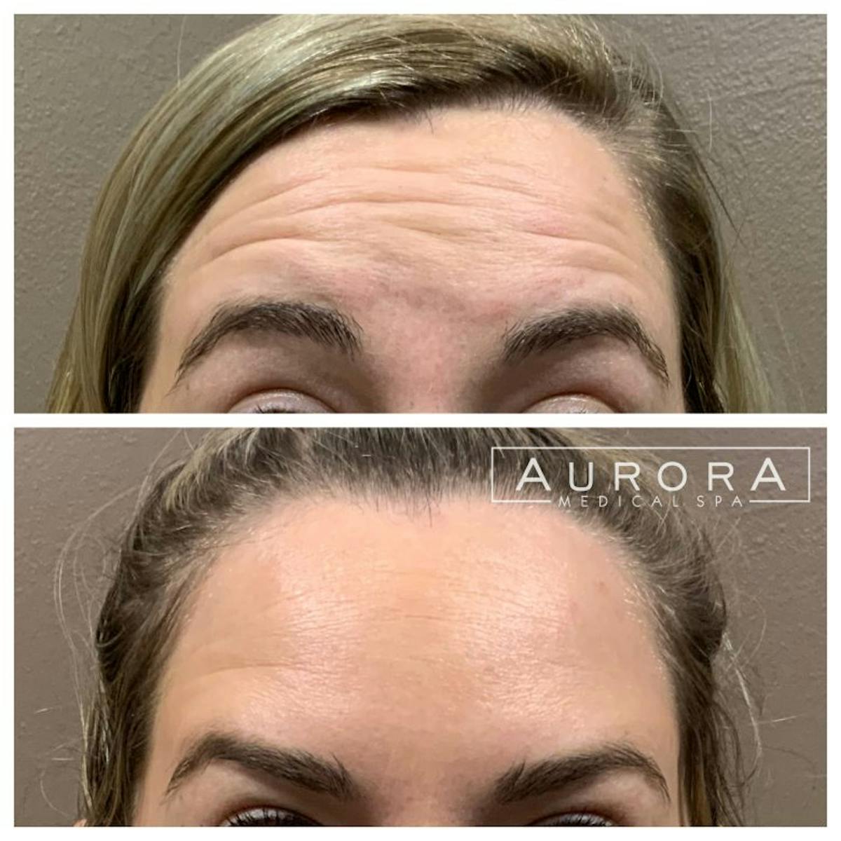 BOTOX Before & After Gallery - Patient 397432 - Image 2