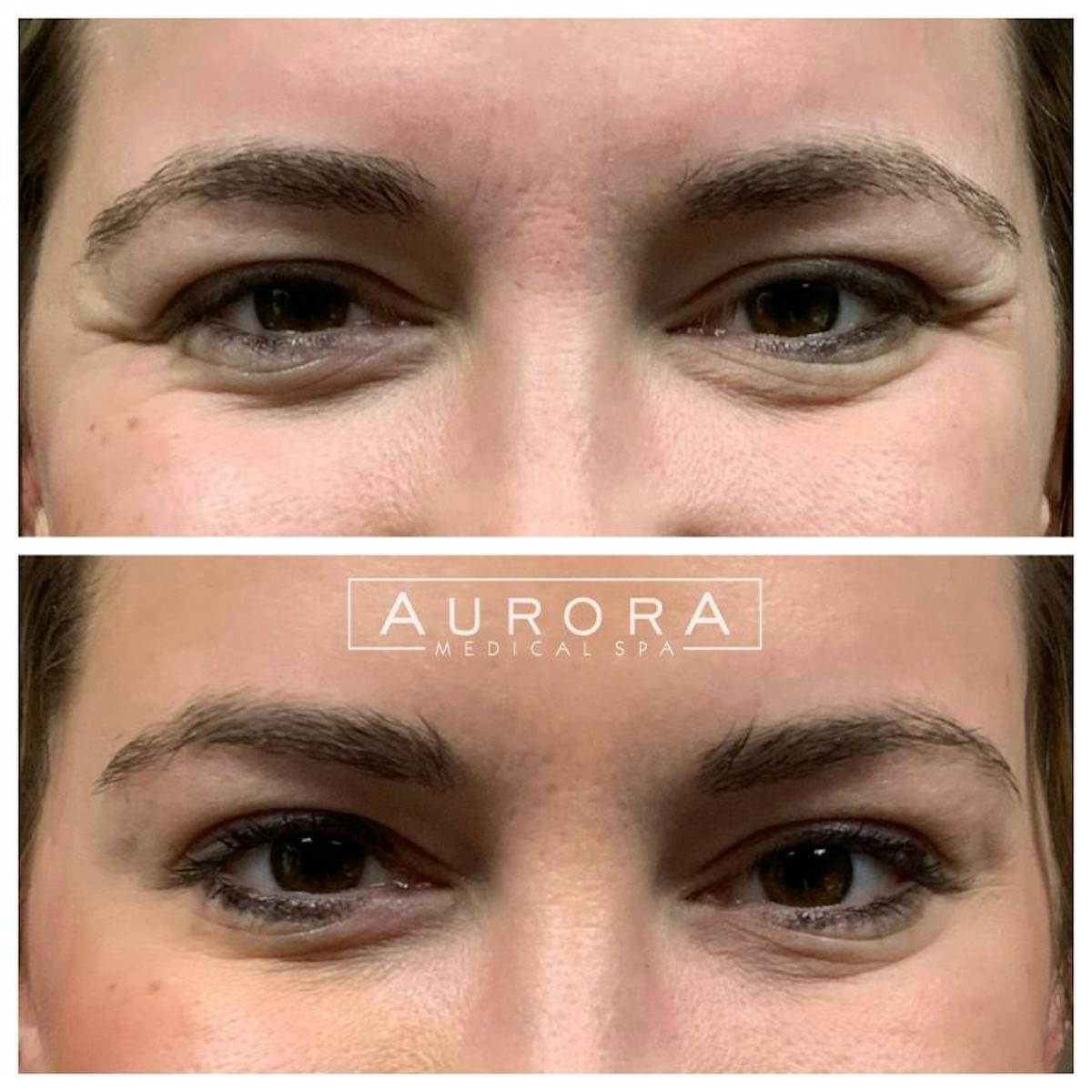 BOTOX Before & After Gallery - Patient 397432 - Image 3