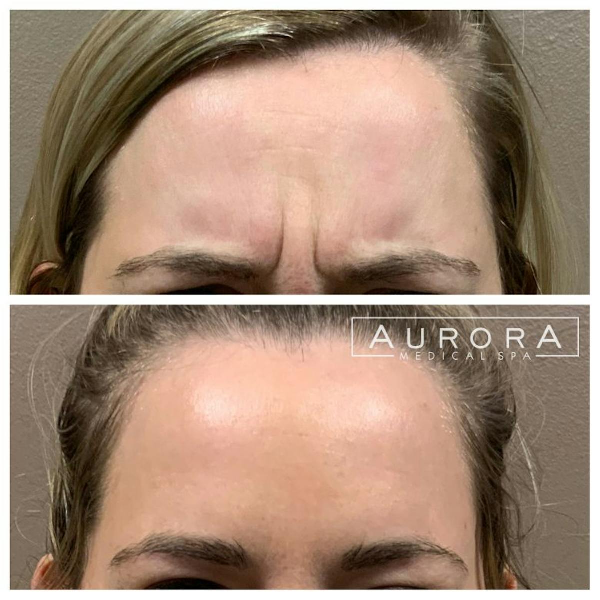 BOTOX Before & After Gallery - Patient 397432 - Image 4