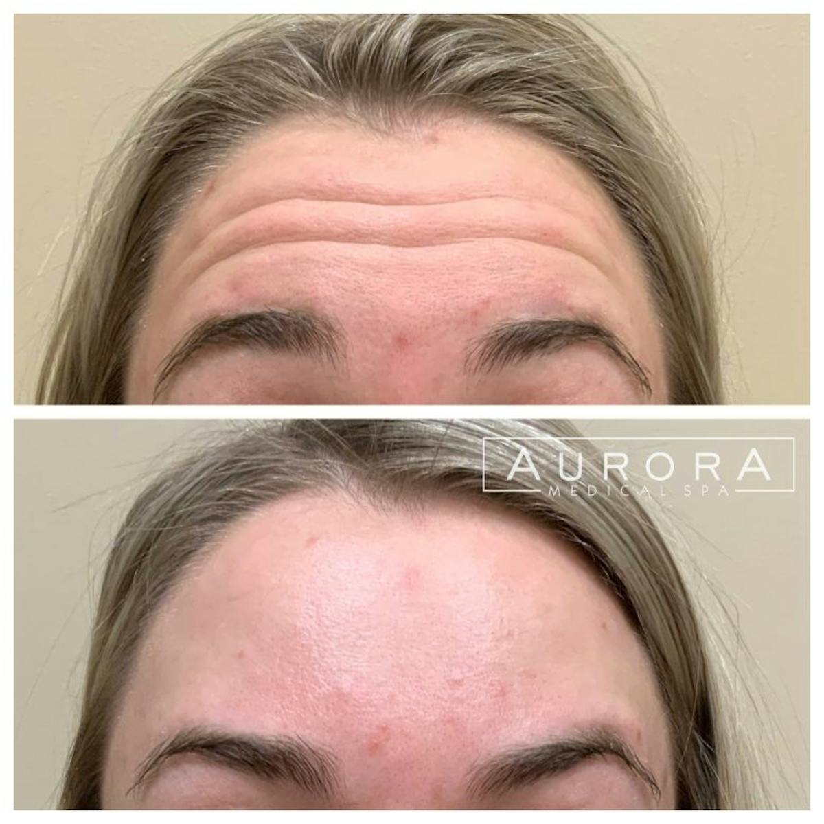 BOTOX Before & After Gallery - Patient 860237 - Image 1