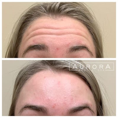 BOTOX Before & After Gallery - Patient 860237 - Image 1