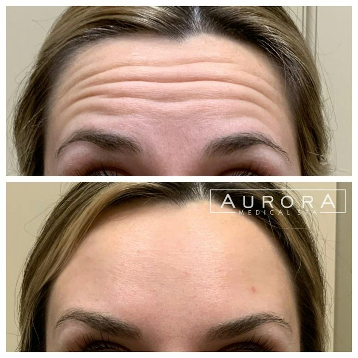 BOTOX Before & After Gallery - Patient 410836 - Image 1