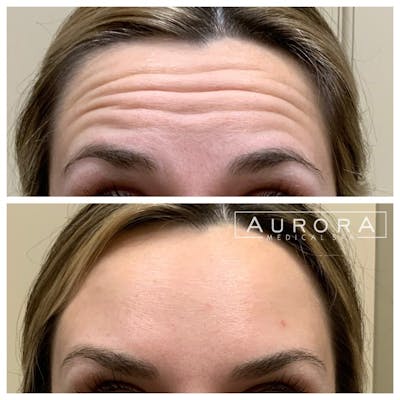BOTOX Before & After Gallery - Patient 410836 - Image 1