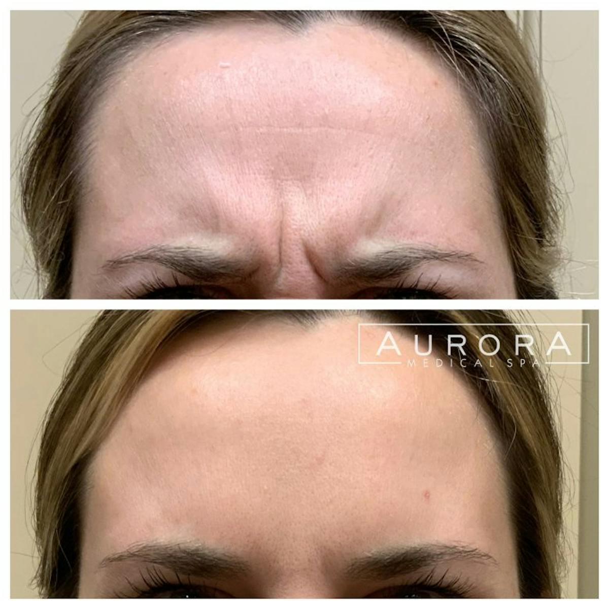 BOTOX Before & After Gallery - Patient 410836 - Image 2