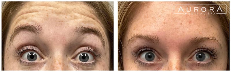 BOTOX Before & After Gallery - Patient 107279 - Image 1