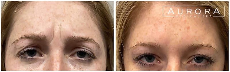 BOTOX Before & After Gallery - Patient 107279 - Image 2